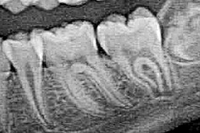 zdjęcie RTG zębów