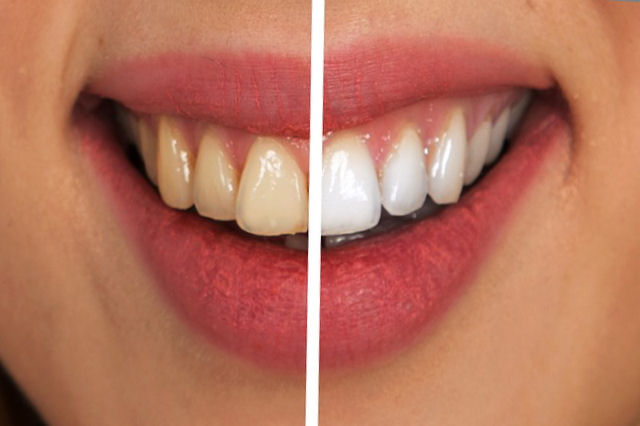 Stomatologia estetyczna - wybielanie  zębów